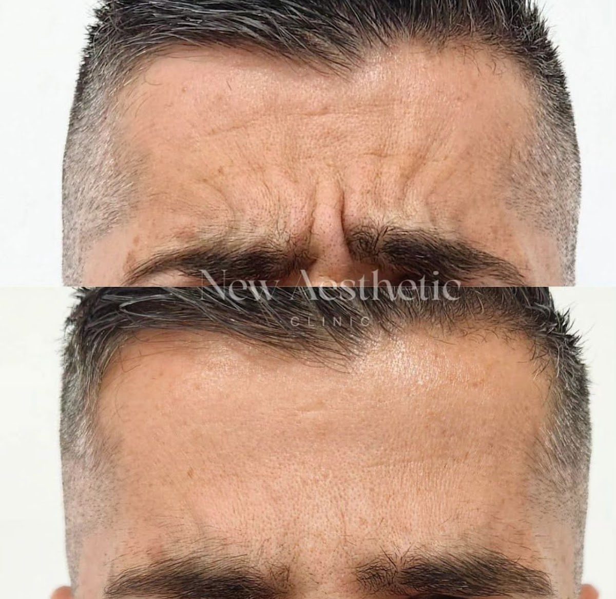 Imágenes del antes y el después que muestran la reducción de las arrugas en la frente, destacando los resultados de la Clínica New Aesthetic.